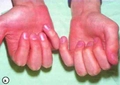 Parmakların Şişmesi Belirtileri ve Tedavisi
