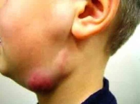 Lenf Bezi Şişmesi Belirtileri ve Tedavisi