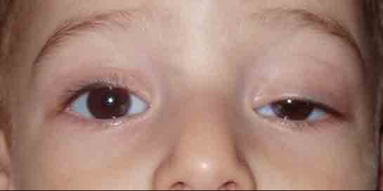 Bebeklerde Göz Kapağı Şişmesi