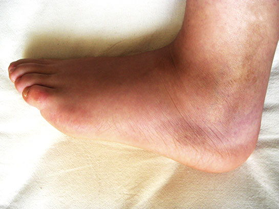 Bilek Şişmesi Belirtileri ve Tedavisi