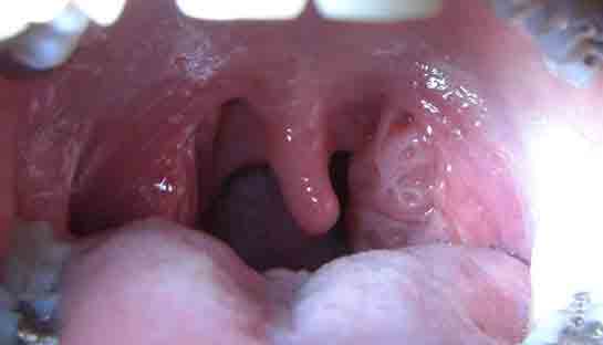 Boğaz Şişmesine Ne İyi Gelir?