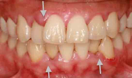 Diş Eti Şişmesine Ne İyi Gelir?